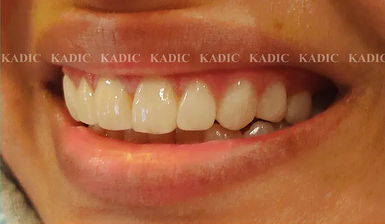 After Image