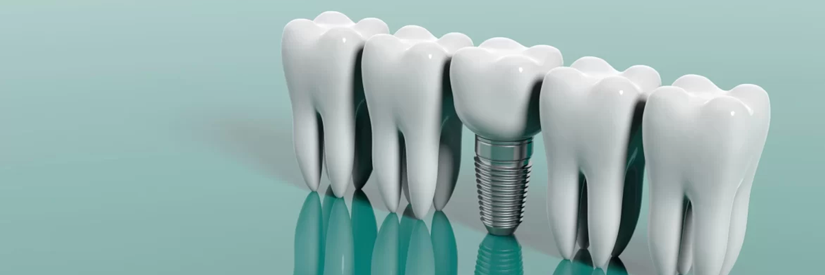 Dental Implants